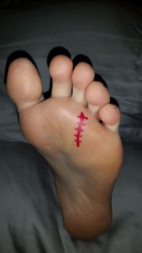 Aesthetic Cosmetic Removal Of Morton’s Neuroma Foot And Ankle