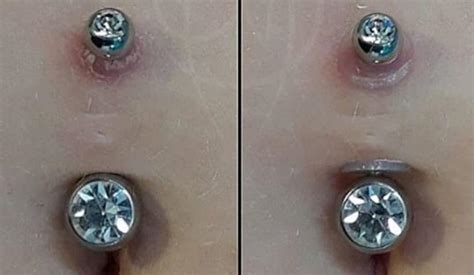 piercing bumps  complete infection  treatment guide