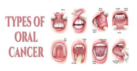 cancer  tongue