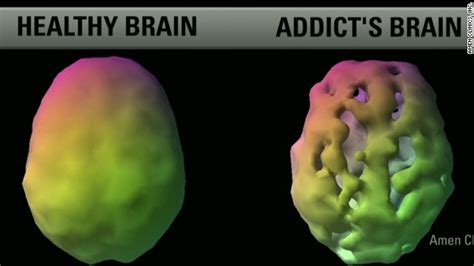 brain scans reveal link between addiction and depression erin burnett