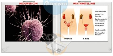 Gonorrhea Causes Diagnosis And Treatment Meduweb Rectal