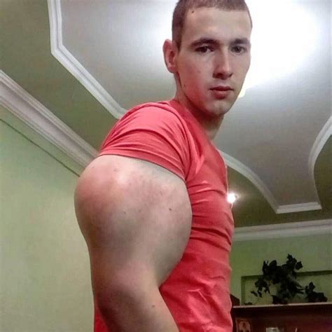 Man Injects Oil To Get Strange Looking Arms The Freaky