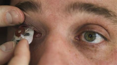 Rob Spence Bionic Eye Toronto Filmmaker Replaces Eyeball With Camera