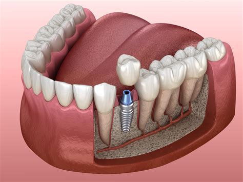 dental implants bridges crowns inverness family dentistry