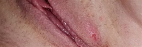blister near vagina porn and erotic galleries in hd quality android