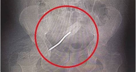 Florida Man Undergoes Surgery To Remove Screwdriver From His Rectum
