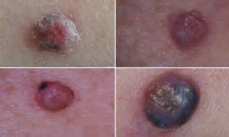 the killer pimple doctors warn of aggressive form of skin cancer which