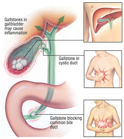 gallbladder pain problems  symptoms diganosis treatment