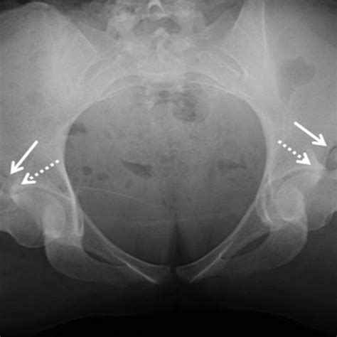 Type Of Femoroacetabular Impingement A Normal Hip Joint B Cam
