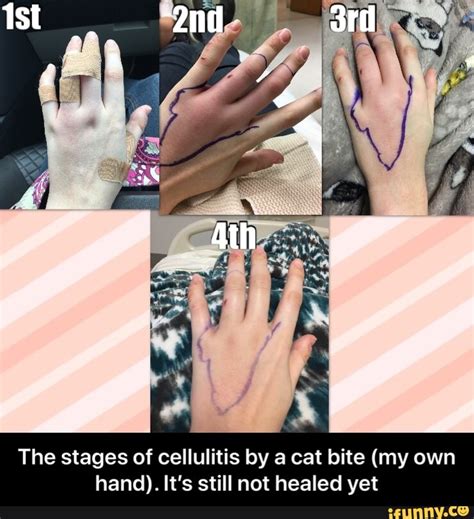 The Stages Of Cellulitis By A Cat Bite My Own Hand Its Still Not