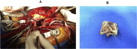 Heart Valve Replacement Of The Patient A The Cardiac