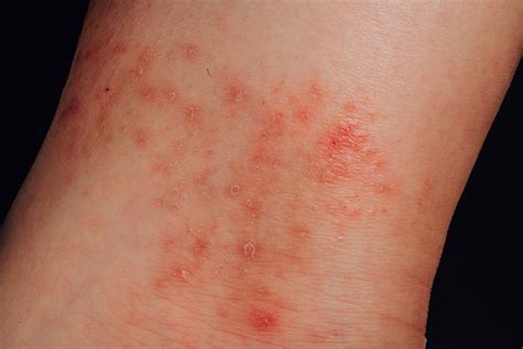 eczema    tratamentos  sintomas na pele minha vida