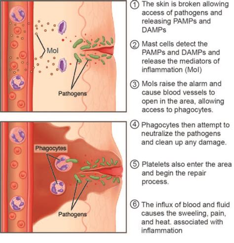 inflammation acute  chronic physiopedia