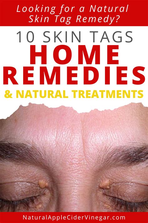 10 skin tags home remedies and natural treatments all natural home