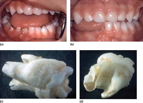 Developmental Defects Of The Dental Hard Tissues And Their Treatment