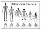 Imperfecta Osteogenesis Oi Clinical Bones Osteogénesis Genetic Brittle Imperfect Collagen Fracture sketch template