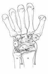 Carpal Ligaments Ligament Instability Volar Bones Wrist Medscape Emedicine Joints sketch template