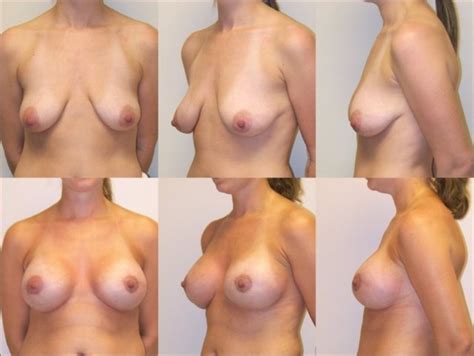 before and after best fake tits porn pics and movies