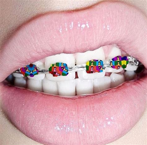 pin by daniela cr on braces braces colors pink braces dental braces