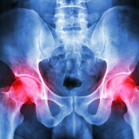 hip arthritis     pain amersham chiropractic clinic