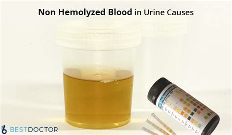 hemolyzed blood  urine  hematuria   pregnancy