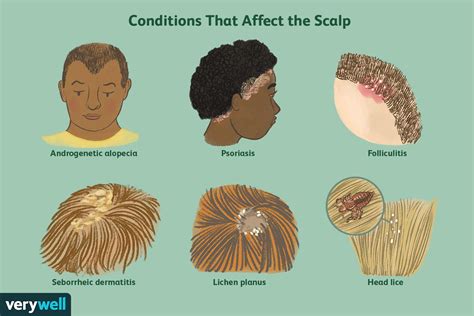 seborrheic dermatitis scalp