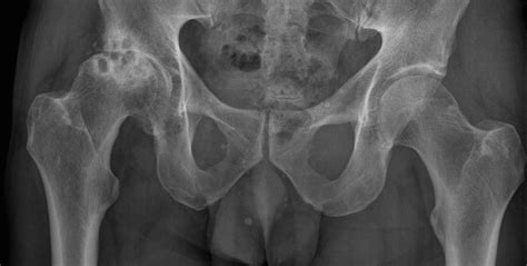osteoarthritis hip radiology  st vincents university hospital