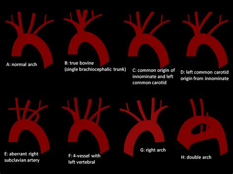 Congenital Anomalies Of The Aortic Arch In Acute Type A Aortic