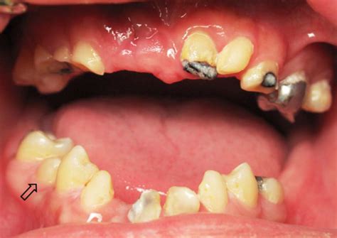 oral health management of a patient with 47 xyy syndrome