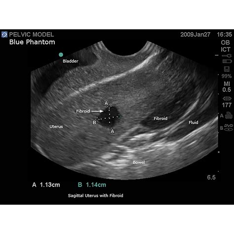 blue phantom general pathology transvaginal ultrasound training model  blue phantom