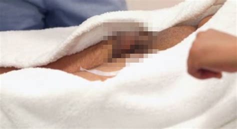 extreme beauty disasters man has penis skinned like a banana after injecting it with vaseline