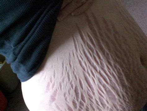 stretch marks everything you need to know man v fat