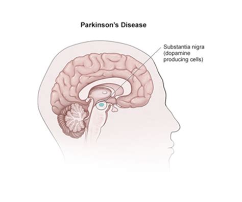 Neurology New Perspectives In Parkinson S Disease Medhelp
