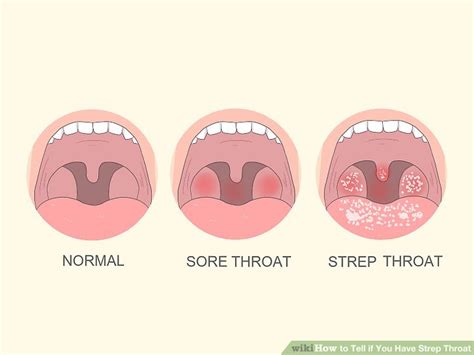 how to tell if you have strep throat with pictures wikihow