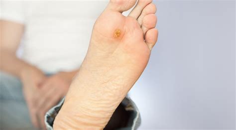 pics  diabetic foot sores diabeteswalls