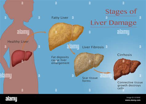 Stages Of Liver Damage Due To Alcoholism First Alcohol