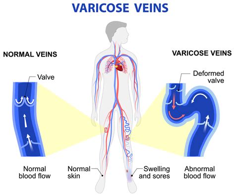 expect   varicose vein screening