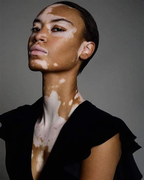 vitiligo causes treatment and cures for the rare skin condition