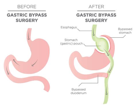 Gastric Bypass Weight Loss Surgery Mr Sam Mehta
