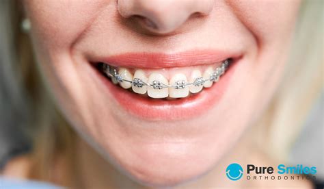 How Do I Know Which Treatment To Choose Pure Smiles Orthodontics Austin Tx
