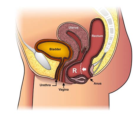 Rectocele Ascrs