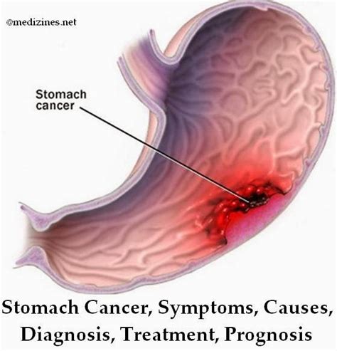 Stomach Cancer Symptoms Causes Diagnosis Treatment Prognosis