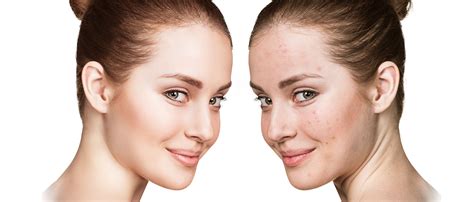 dermatix the science of dermatix acne scar dermatix® malaysia