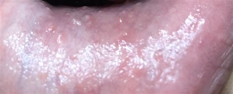 bumps inside bottom lip anyone see or know anything