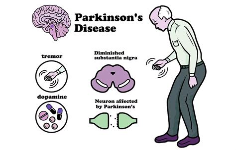 parkinson treatment neurotherapy punjab neurotherapist punjab