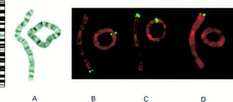 A Case Of Ring Chromosome 2 With Growth Retardation Mild Dysmorphism