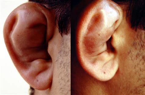 fonopatologia grupo  otohematoma patologia de oido externo