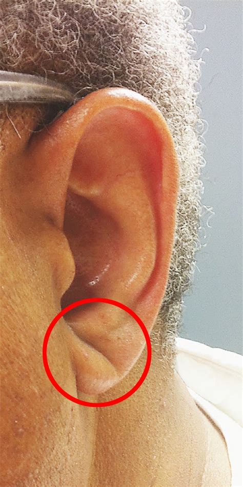 If Your Ear Lobe Looks Like This You Could Be At Higher Risk Of A