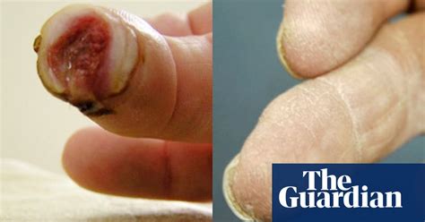 The Missing Finger That Never Was Medical Research The Guardian