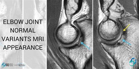 elbow joints normal variants  mri radedasia